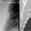 Tapered margins sign
Pleural or extrapleural origin