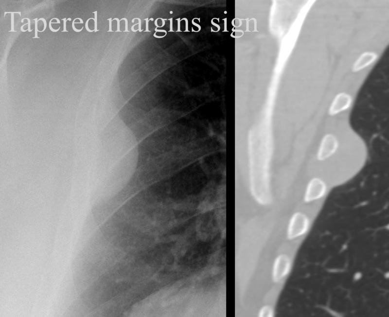 Tapered margins sign
Pleural or extrapleural origin