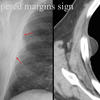 Tapererd margins sign
Pleural lipoma