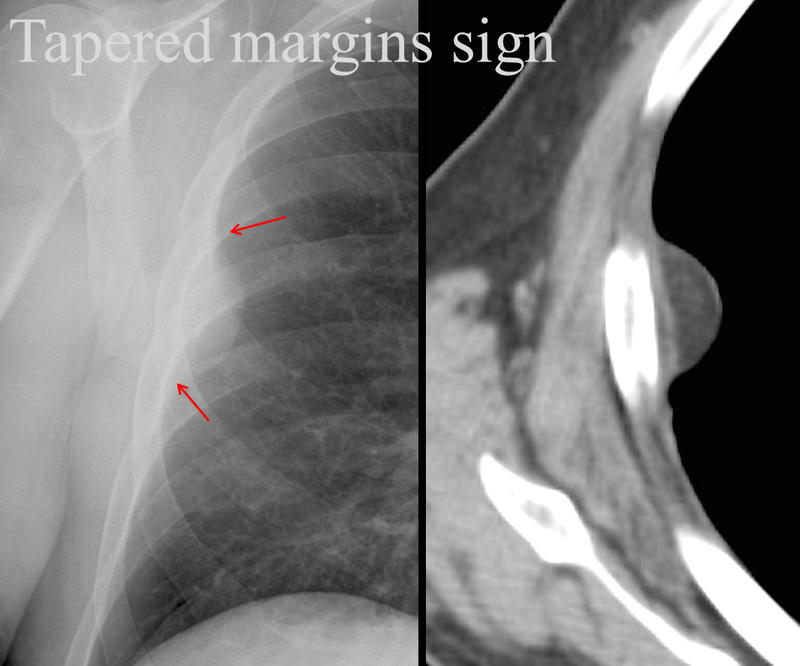 Tapererd margins sign
Pleural lipoma