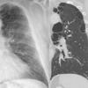 paraseptal emphysema