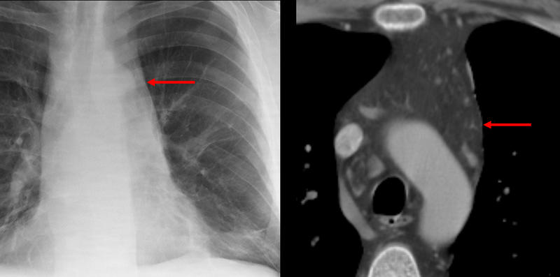 mediastinal fat