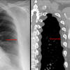 subpleural fat