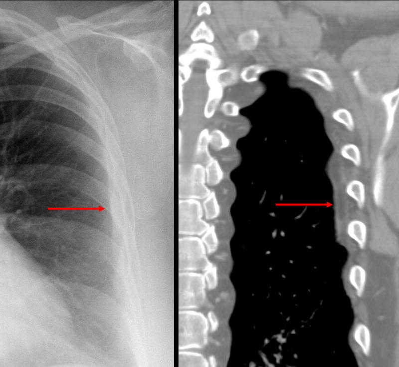 subpleural fat