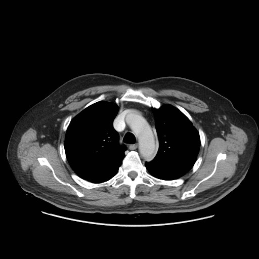 Ao nipple axial