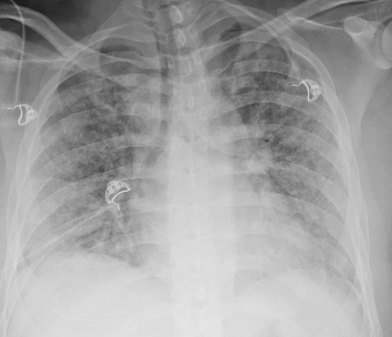 TRALI (transfusion reaction)