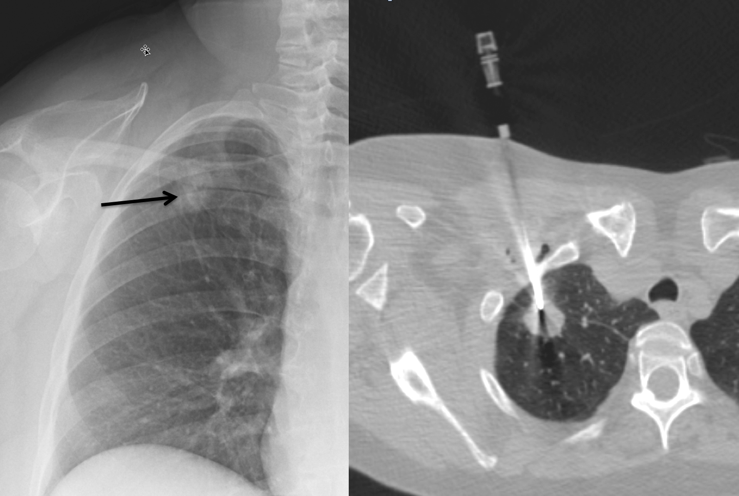 CT guidsed biopsy