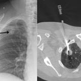 CT guidsed biopsy