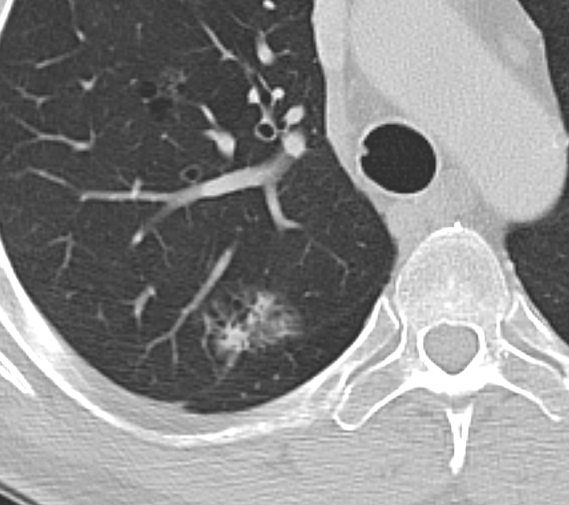 adenocarcinoma