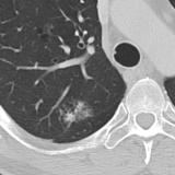 adenocarcinoma