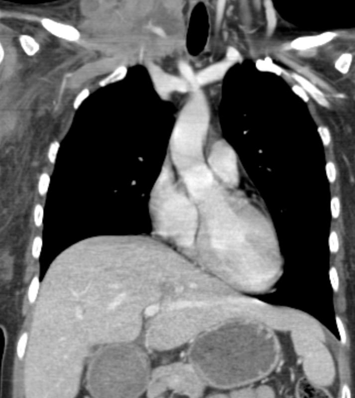 lymphoma coronal CT