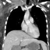 lymphoma coronal CT