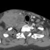 lymphoma (NHL) axial CT