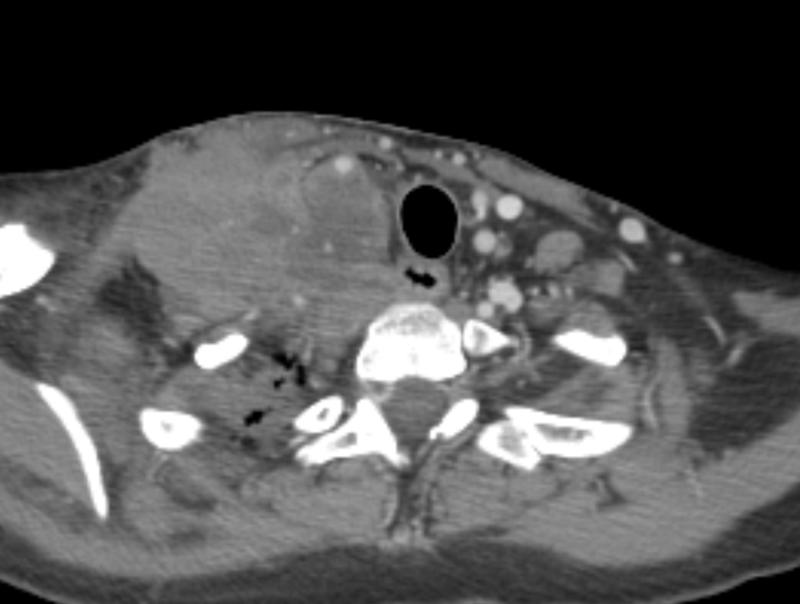 lymphoma (NHL) axial CT