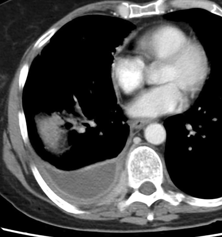 split pleura 2