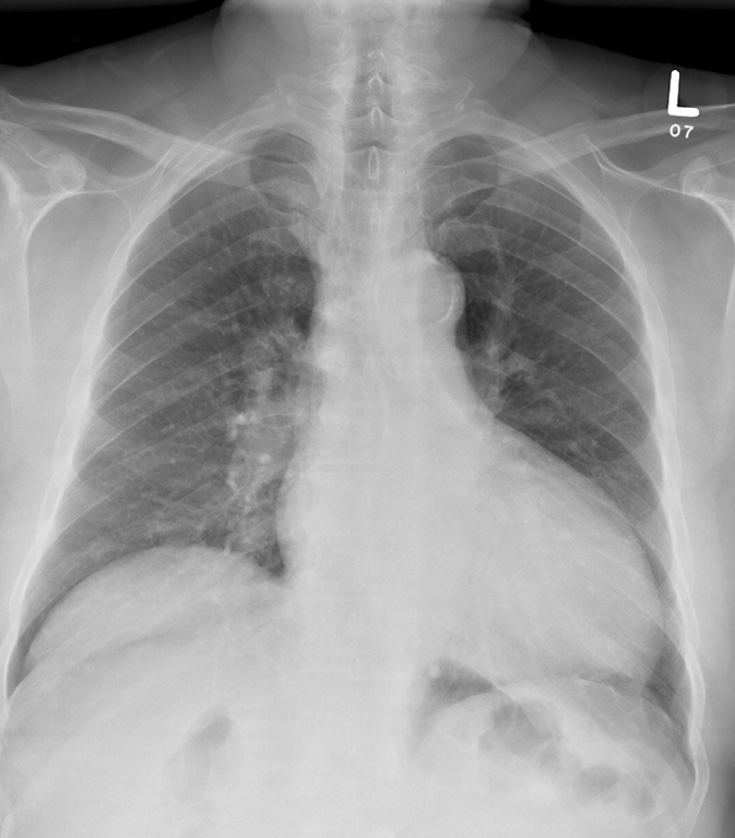 ischemic LV