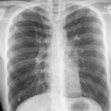 Asthma PnMed PA
