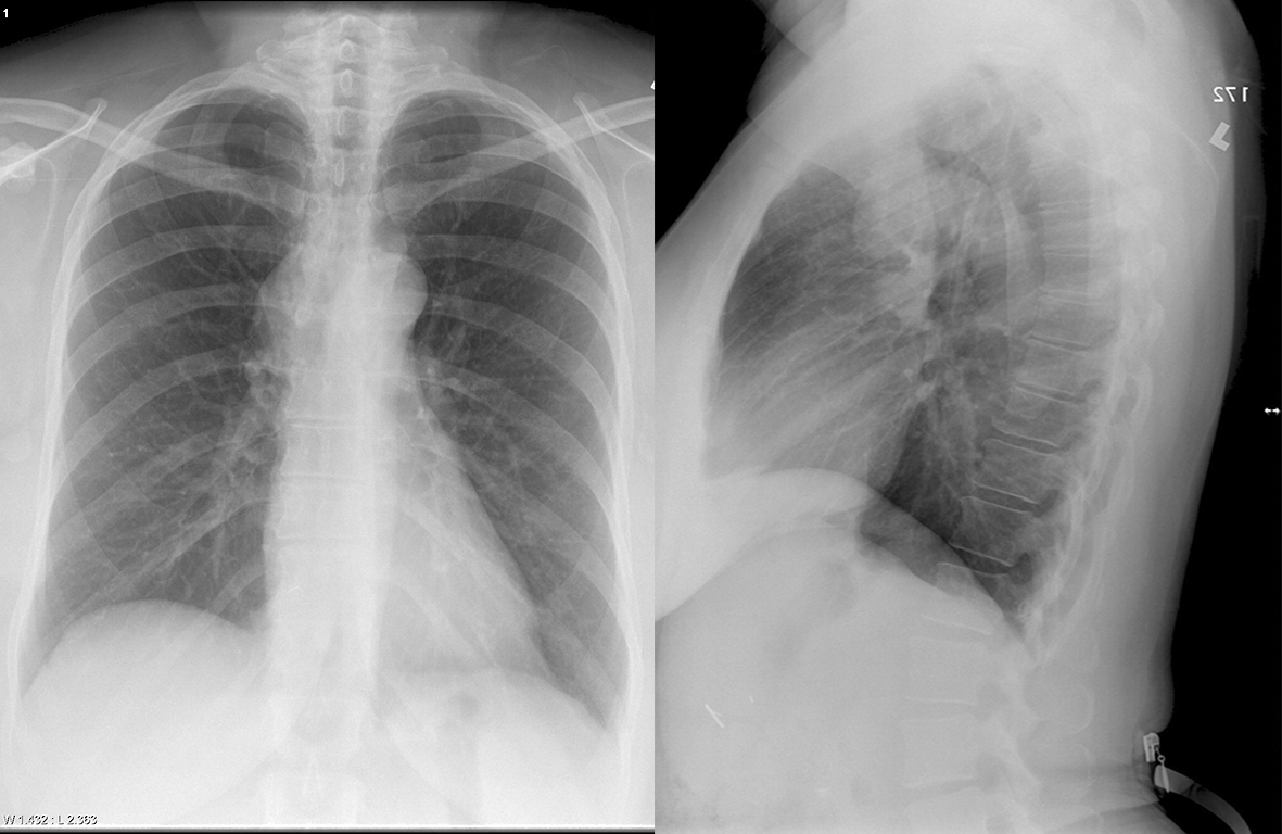 Br cyst Pa and Lat