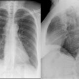 Br cyst Pa and Lat