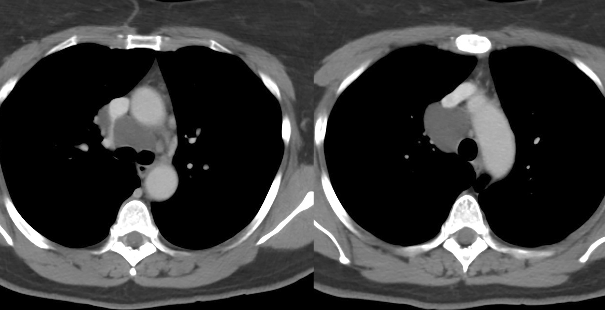 Br Cyst CT