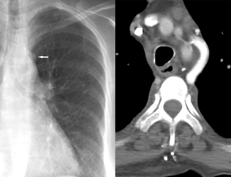 Aortic nipple PA and CT