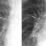 peribronchial cuffing