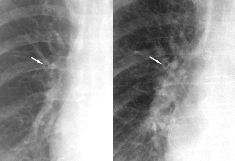 peribronchial cuffing