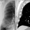 subpleural - fat