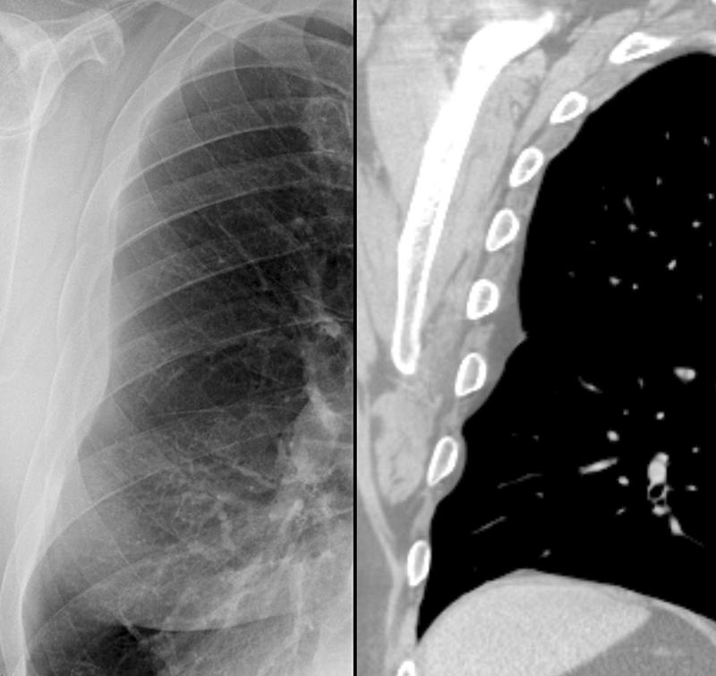 subpleural - fat