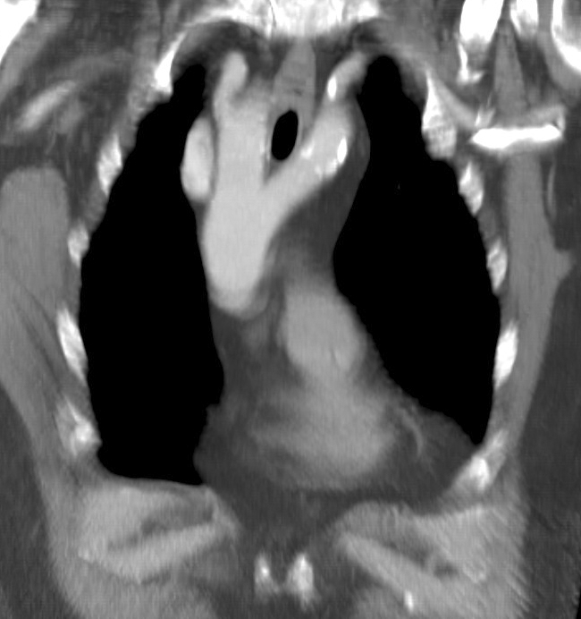Double arch CT