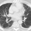 Asbestos 7 CT