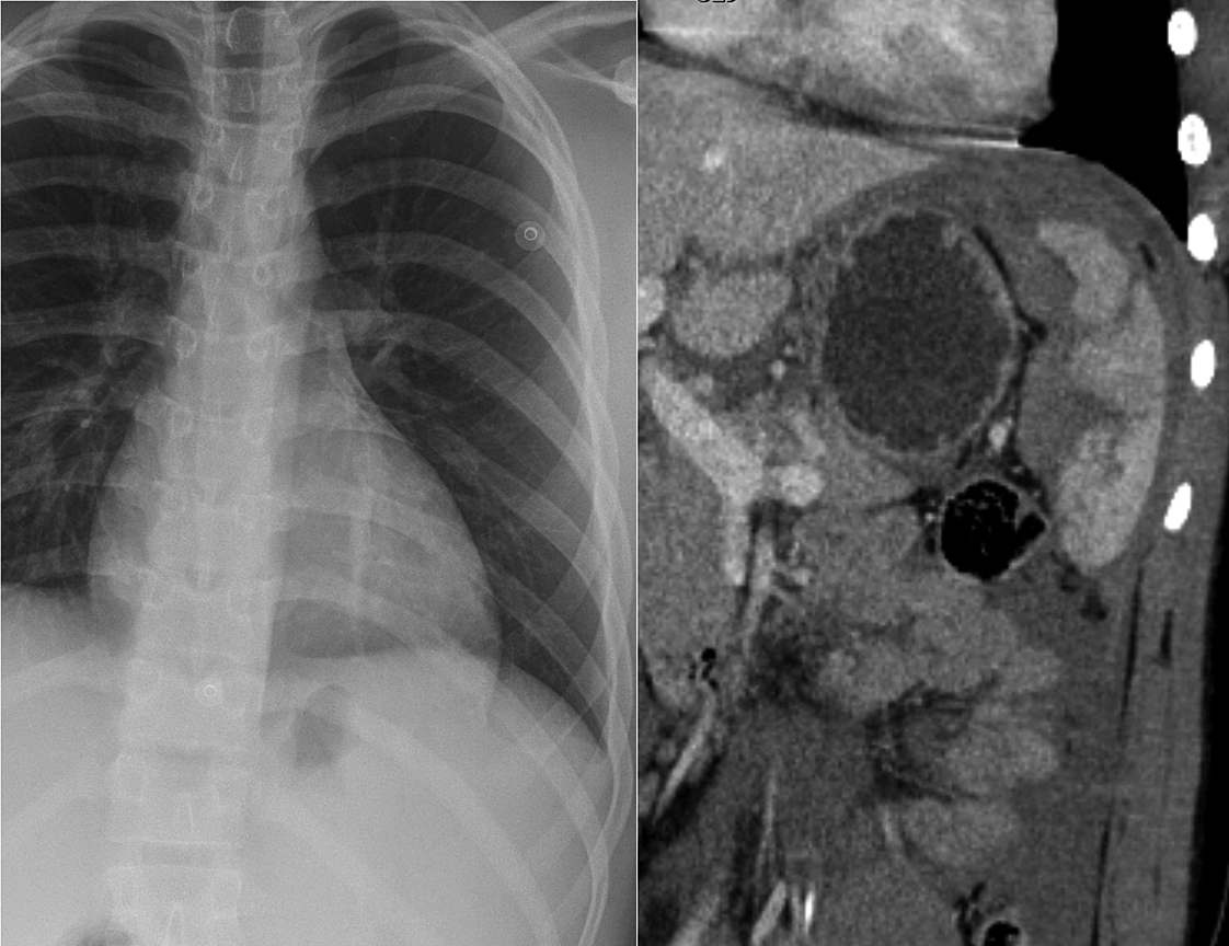 Splenic injury