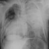 Cardiac torsion post BCT