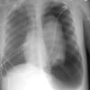 Pneumothorax