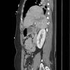 Rupt Rt HD sagittal 