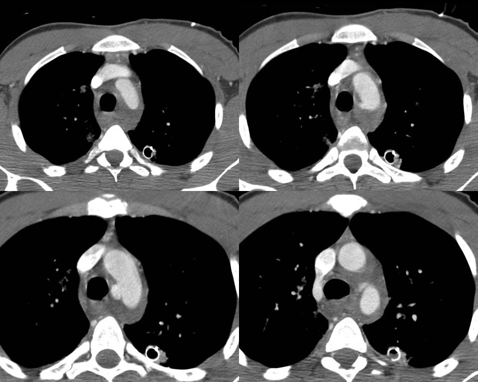 Case 14a