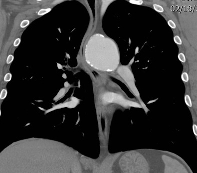 Chronic TAI CT coronal