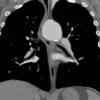 Chronic TAI CT coronal