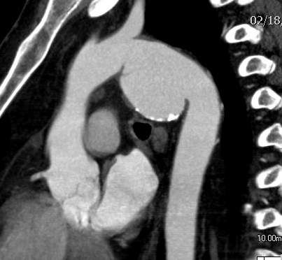 Chronic TAI CT sagittal