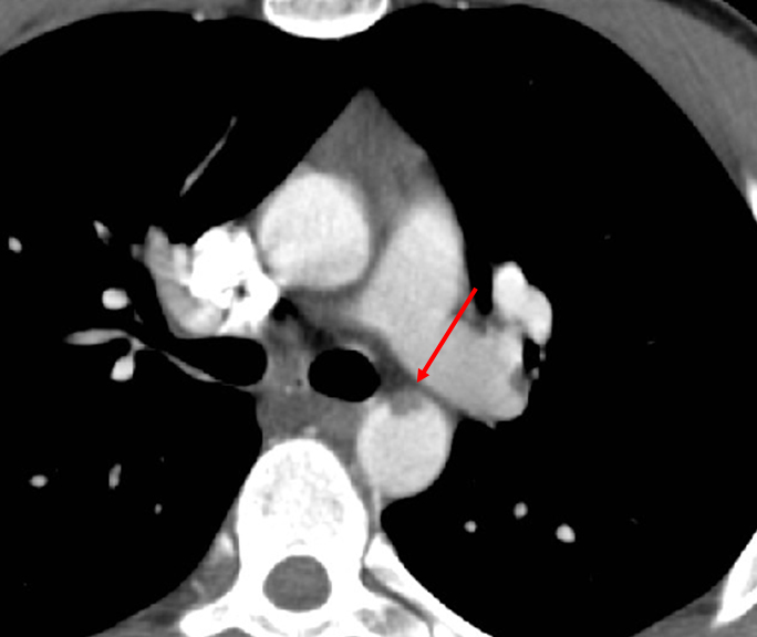 Min Aortic Injury