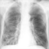 Bronchiectasis
Case 1 PA