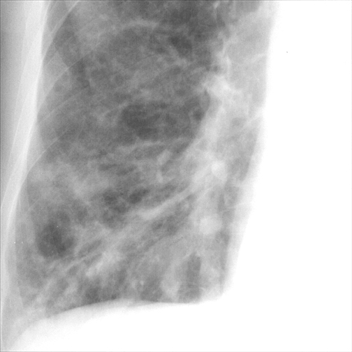 Bronchiectasis
Case 1 PA c/u