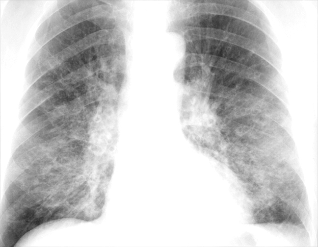 Bronchiectasis
Case 2 PA