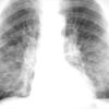 Bronchiectasis
Case 2 PA