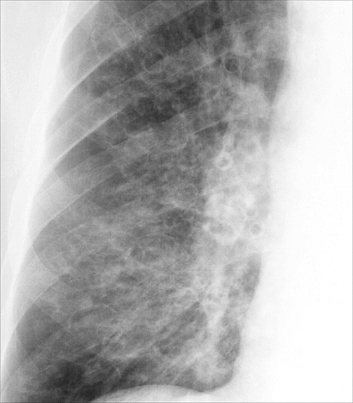 Bronchiectasis
Case 2 PA c/u