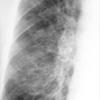 Bronchiectasis
Case 2 PA c/u