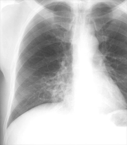 Bronchiectasis
Case 3 PA