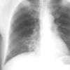 Bronchiectasis
Case 3 PA