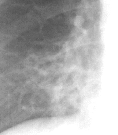 Bronchiectasis
Case 3 PA c/u