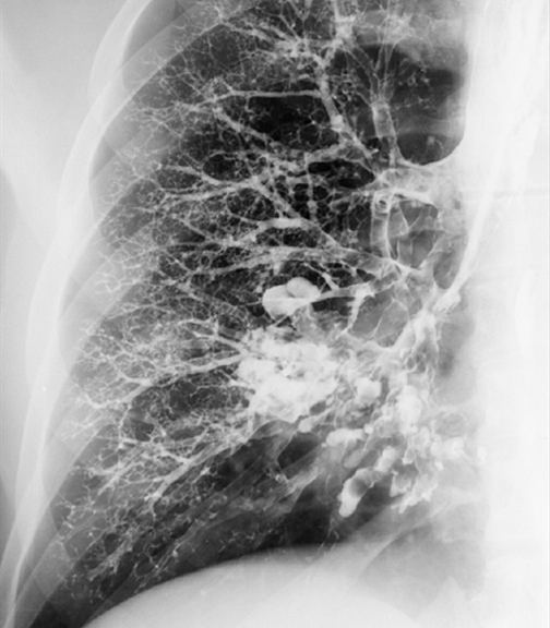 Bronchiectasis
Case 3 PA bronchogram